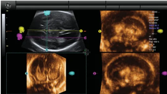 Figure 2 Example of application of our new algorithm in a fetus with complete agenesis of the corpus callosum