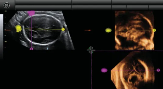 Figure 3 Example of application of our new algorithm in a fetus with classical Dandy–Walker malformation