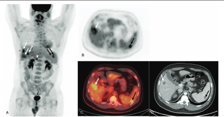 Figure 1. At baseline. 18 F-FDG PET/CT scan with contrast. (A) 3D MIP image in coronal view shows multiple hepatic lesions (white arrows), a retroperitoneal lymph node lesion (white arrowhead), and a splenic lesion (black arrows)