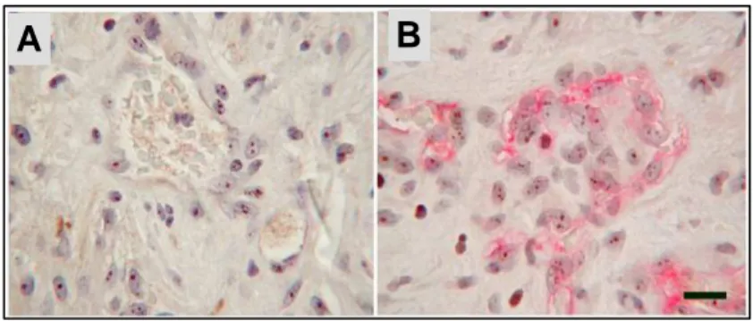 Figure 8: Immunostaining on human glioblastoma section. A: Nuclear staining  with hTERT antibody both on glial neoplastic cells and endothelial cells