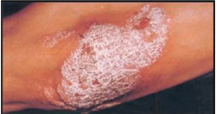 Figura 5: Placca eritemato-squamosa con le tipiche squame bianco argentee caratteristica della psoriasi       (Amerio et al.,2003) 