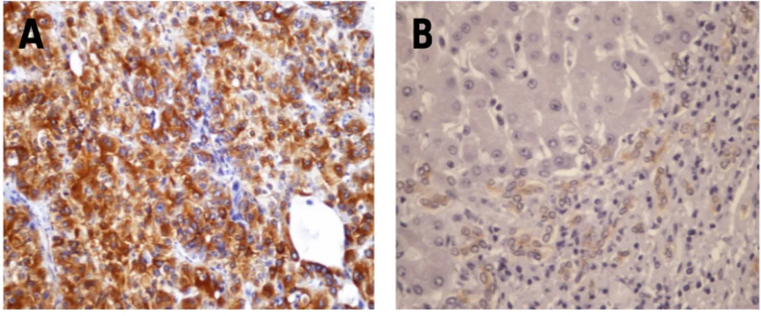 Fig. 7: Immunoreattività (IR) all’-tubulina. In (A), HCC con diffusa IR citoplasmatica all’-tubulina  (20x); in (B), fegato non tumorale con parenchima non immunoreattivo e con dotti biliari positivi,  (controllo interno) (20x)