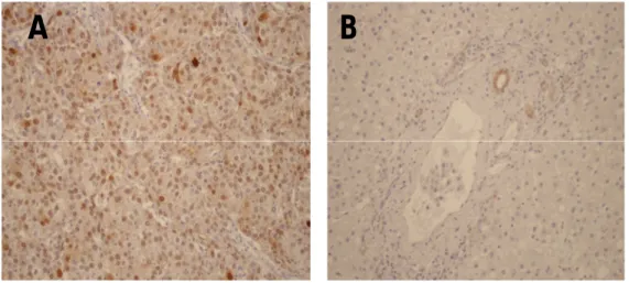 Figura 18. In (A), HCC, diffusa IR nucleo-citoplasmatica all’HSP70 (20x); in (B), fegato non tumorale,  negativo,  dotti biliari come  controllo interno (20x)