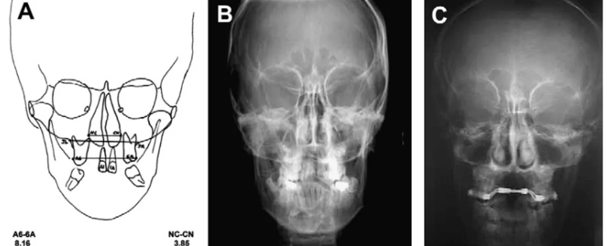 Fig. 1. (A–C) Cephalometric assessment before and after RME (mean data values). Anatomic changes in whole sample: all cross-sectional diameters increased at intermaxillar and  inter-molar level