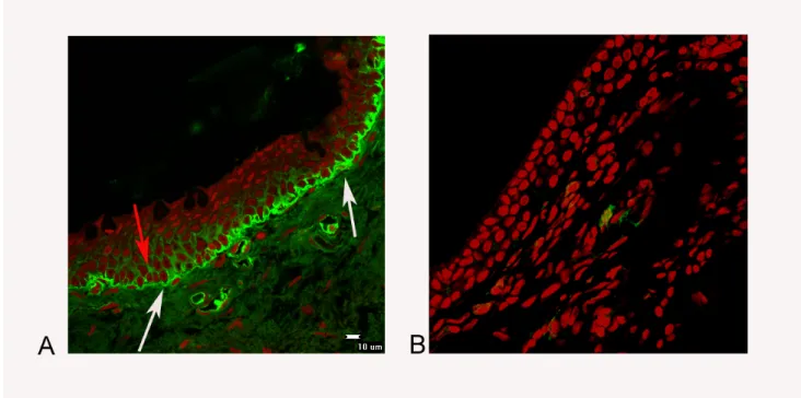 Figura 5.5: Diagnostica per OCP. A: immunofluorescenza positiva per IgGAM (Cy2/verde) a livello della membrana basale congiuntivale (freccia bianca) e in alcuni punti della sostanza intercementante dell’epitelio stesso (freccia rossa), ottenuto da un pazie