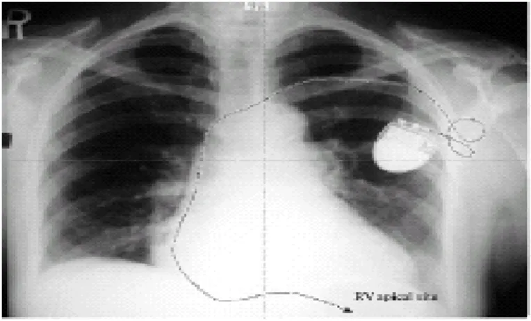 Fig. 10. Elettrocatetere ventricolare posizionato in apice ventricolare destro. 