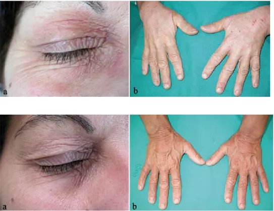 Fig.  1.  (A)  Blepharitis  and  eczema  on  eyelids  before  treatment.  (B)  Erythematous-desquamative lesions and  diffused lichenification on both hands  before treatment