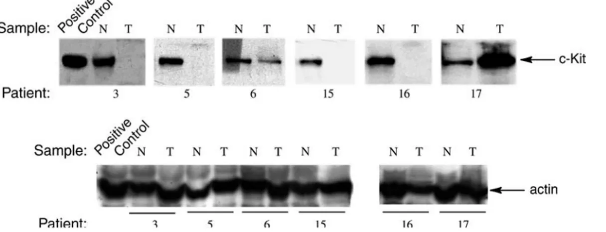 Fig. 2 C-KIT protein expression in colon carcinomas. Western blot analysis was performed using the anti-c-KIT antibody