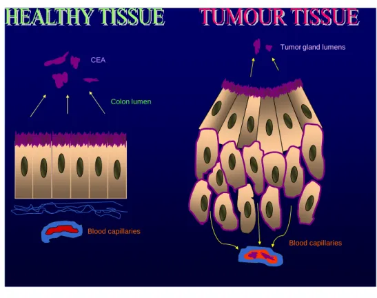 Figure 13. CEA distribution  in healthy  and tumour colon tissue epithelia 
