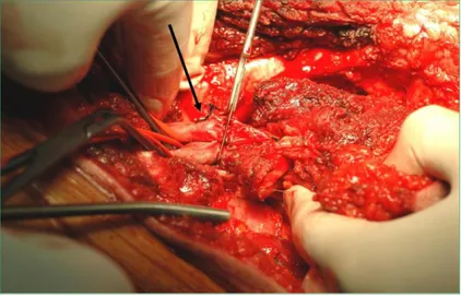 Figure 1: Intraoperative image. The scalpel resets the neoplasia proximally. The non involved vessels are clamped