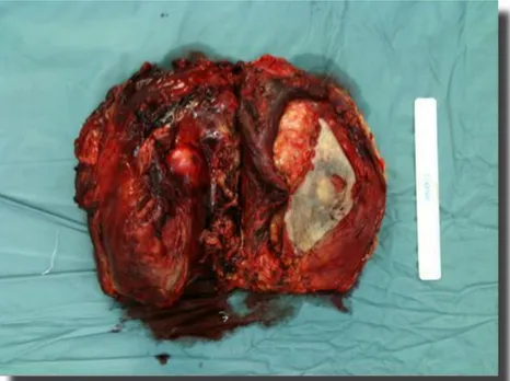 Figure 5: Intraoperative specimen of sarcoma after the surgical removal. 