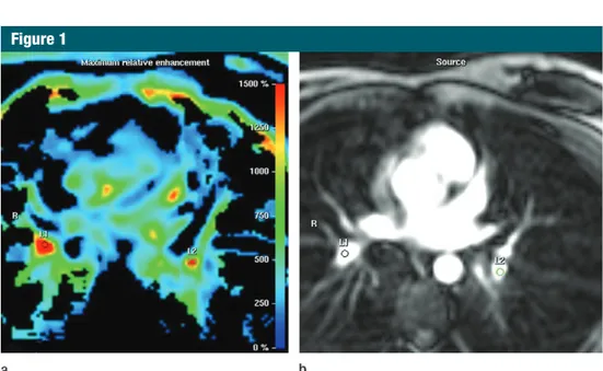 Figure 1:  Transverse MR images in 58-year-old woman with CPFE show ROI positioning. (a) ROIs were  drawn manually on the color-coded maps over the areas of the pulmonary vessels showing the highest  rela-tive maximal signal intensity projection values (re