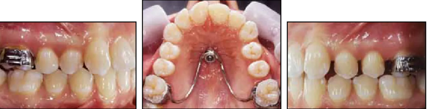 Fig. 6  Distal drifting of premolars after molar distalization.