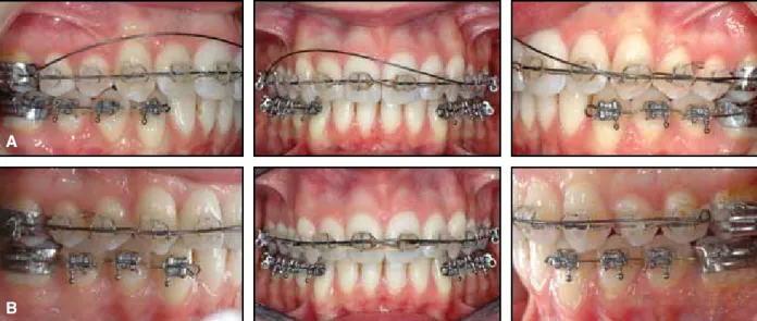 Fig. 8  A. Lower brackets bonded from canines to first molars for finishing; upper overlay wire placed for  asymmetrical intrusion to align anterior gingival margin