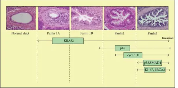 Fig. 1: Progressione delle alterazioni molecolari PanIN 