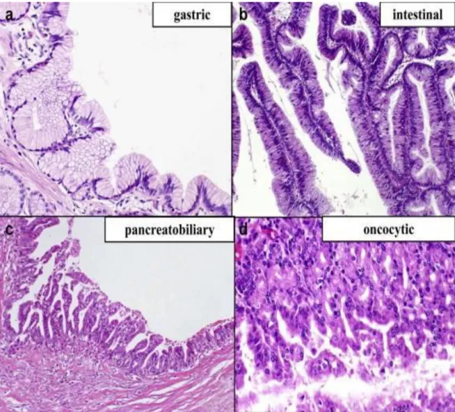 Fig. 3: Classificazione istologica di IPMN 