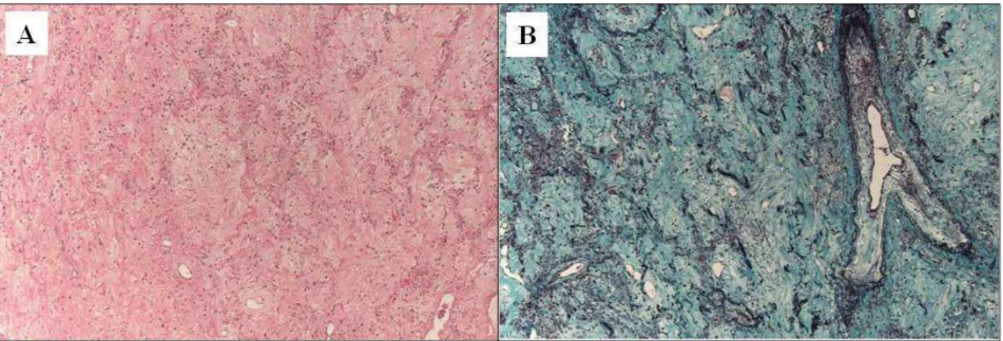 Figure  1.5.  Pleuroparenchymal  fibroelastosis:  areas  of  pleuroparenchymal  fibroelastosis  characterized  by  confluent  areas  of  hypocellular  collagen  deposition  with  preservation  and  thickening  of  the  alveolar  septal  elastic  framework