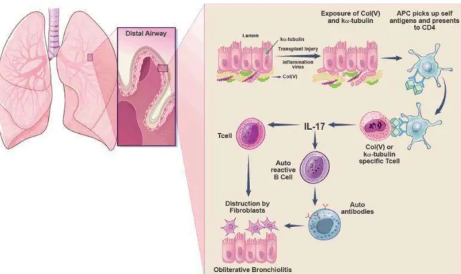 Figure 1.7.  Autoimmunity in lung transplantation. After transplantation, exposure of collagen type  V  [col(V)]  and  K-α1  tubulin  triggers  autoimmune  responses,  both  humoral  and  cell  mediated,  which contribute to chronic rejection and obliterat