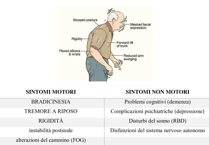Fig 6. Manifestazione clinica e i sintomi del Parkinson (30) 