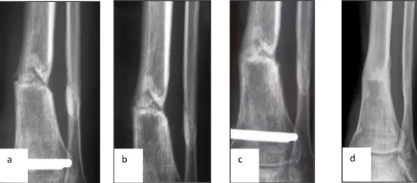 Figura 10 a) pseudoartrosi atrofica in una frattura di tibia distale. b,c) controlli radiografici a 1 e 6  mesi  che mostra processi consolidativi  in  atto;  d)  rimozione  del fissatore  esterno  per  avvenuta  consolidazione della frattura.