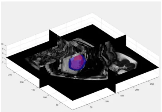 Figure  7.  Three-dimensional  rendering  of  detected  endocardial  (red)  and  epicardial  (surfaces) in the CMR volume 