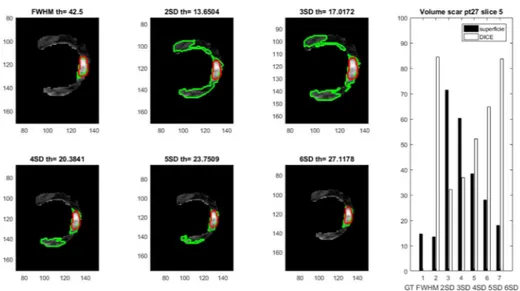 Figure  10.  Scar  detection  results  in  slice  #5,  pt.27,  applying  the  different  approaches,  (reference GT in red, automated approaches in green); scar volumes obtained applying the  different approaches are reported on the right panel