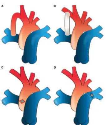 Figura 3 . Tipi di shunt sistemico-polmonare. A. BT shunt; B. BT shunt modificato,  C