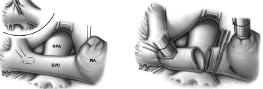 Figura 9 Anastomosi cavopolmonare bidirezionale, tecnica chirurgica.      