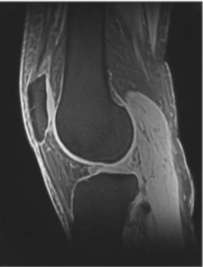Fig. 5 RMN del ginocchio 