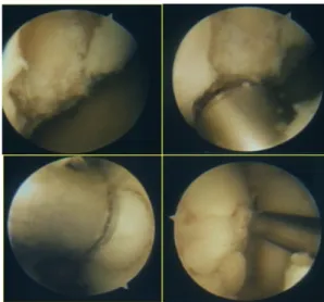 Fig. 7 Tecnica chirurgica di mosaicoplastica: visualizzazione artroscopica intraoperatoria  b)  Il  trapianto  osteocondrale  massivo  si  impiega  nelle  gravi  perdite  sia  di  tessuto 
