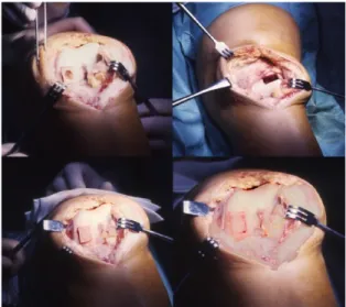 Fig. 8 Tecnica chirurgica trapianto osteocondrale massivo 