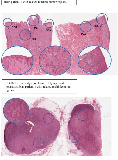 FIG 17. Hematoxylyn and Eosin  of primary tumour  from patient 1 with related multiple tumor regions