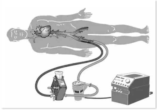 Figura  5:  Rappresentazione  schematica  di  impianto  di    un  ECMO  periferico 