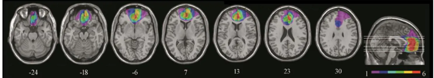Figure  3.  extent  and  overlap  of  brain  lesions.  The  figure  represents  vmPFC  patients’  lesions  projected  on  the  same  seven axial slices and on sagittal view of the standard Montreal Neurological Institute brain