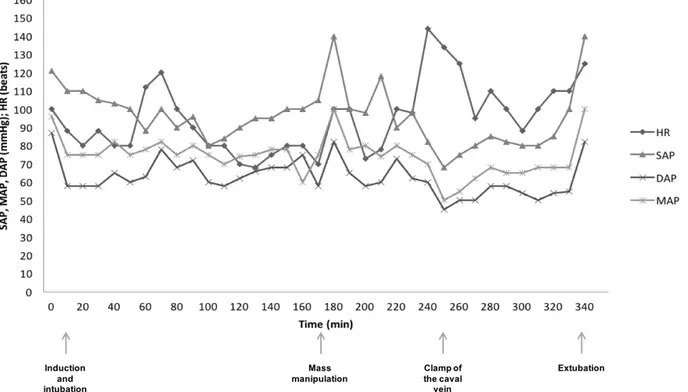 Figure  2-  Cardiovascular  parameters  for  CASE 2  recorded  before  sedation,  at  induction  and  intubation, during mass surgical manipulation (T170), during vena cava clamping (T240) and at the  time of extubation (T340): Heart rate (HR), systolic ar