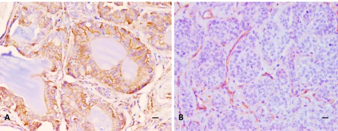 Figure  2.  IHC  labelling  with  anti-P-GP  antibody.  (A)  Tubulopapillary  carcinoma  with  intense  membranous  and  weak  cytoplasmic  expression  of  P-gp  in  the  epithelial  component
