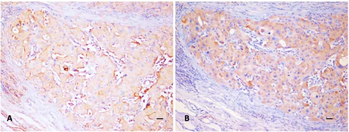 Figure 4. IHC labelling with anti-P-gp antibody (A) and anti-BCRP (B). Solid carcinoma