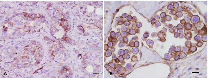 Figure 2. IHC labelling with anti-P-gp antibody. (A) Primary tumor of inflammatory carcinoma with  intense membranous expression of P-gp in malignant epithelial cells