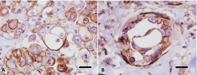 Figure  4.  IHC  labelling  with  anti-P-gp  antibody.  (A)  Neoplastic  cells  of  mammary  inflammatory  carcinoma  with  severe  anisokaryosis  and  anysocytosis,  characterized  by  a  rim  of  elongated  cytoplasm containing eccentric nuclei, encircli