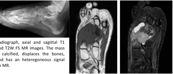 Figure	2.	Radiologic	presentation	of	a	synovia	sarcoma	in	a	foot.	