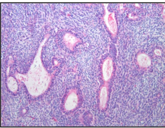 Figure	 3.	 Biphasic	 synovial	 sarcoma:	 granular	 and	 spindle	 cell	 component	 intermixed	 in	 the	 same	tumor.	