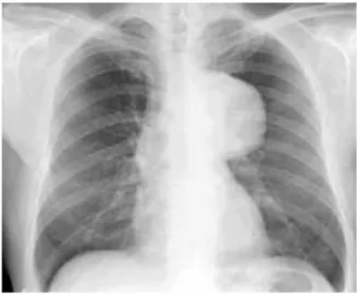 Fig. 5 RX- torace aorta toracica aneurismatica 