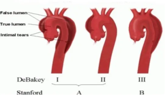 Fig. 10 Classificazione dissezioni aortiche secondo DeBakey e secondo Stanford 