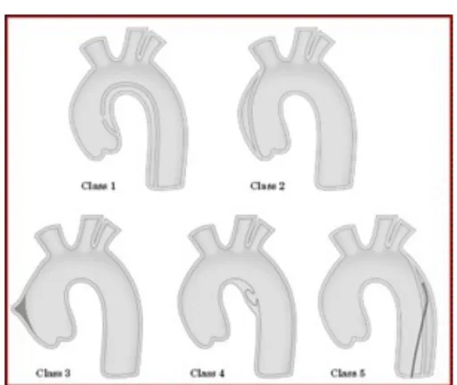 Fig. 12 Classificazione dissezioni aortiche secondo Svensson 