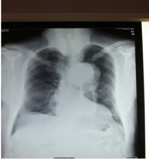 Fig. 14 RX – torace aorta toracica dissecata 