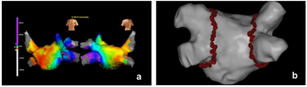 Figure 1.4: a) Electroanatomical map; b) 3D reconstruction of the LA with circumferential ablation lesions (red points) arround the ostia pf the PVs