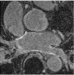 Figure 1.6: Example of a LGE-MRI acquisition. The bright region represents the fibrotic tissue on the atrial wall.