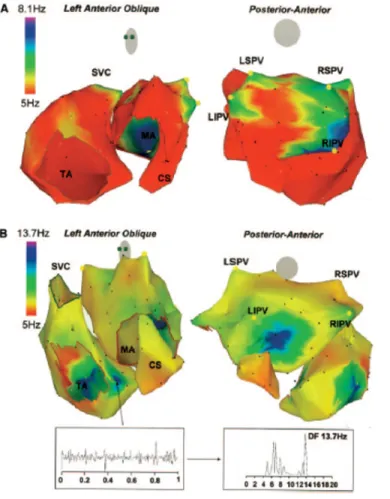 Figure 1.12: A) 3D DF maps in patient with paroxysmal AF. High DF sites are located in each PV