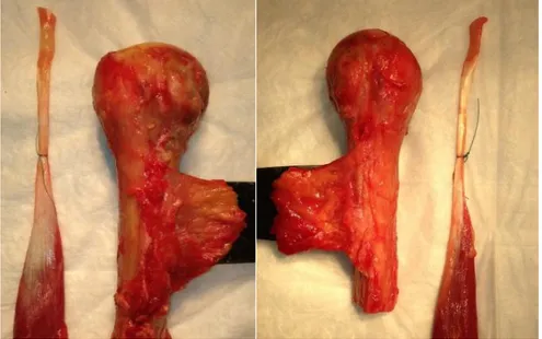 Figura 11: spalla destra e sinistra alla fine della dissezione. L’omero è stato liberato  da tutti i tessuti molli mantenendo solo l’inserzione del pettorale maggiore