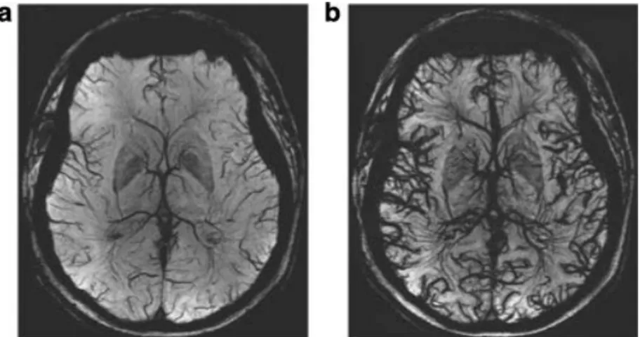 Figure  31.  Ferumoxytol  susceptibility-weighted  imaging  at  7  T  in  human  brain  Vasculature  MRI  before  ferumoxytol (a) and after 4 mg/kg ferumoxytol (b)